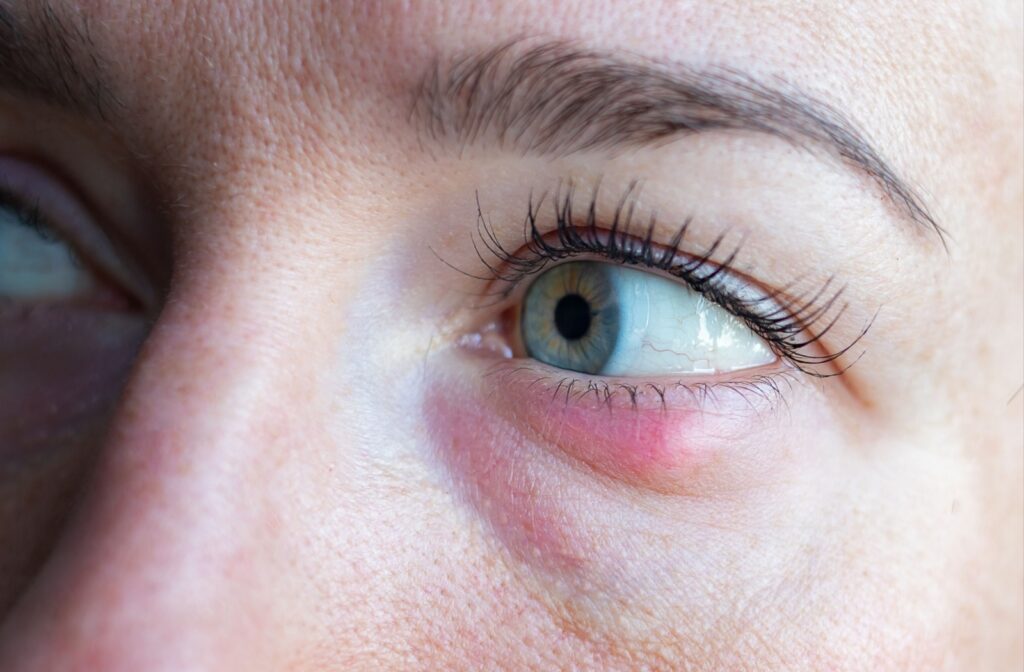 Close-up of a red bump on the bottom eyelid of a green-eyed person.